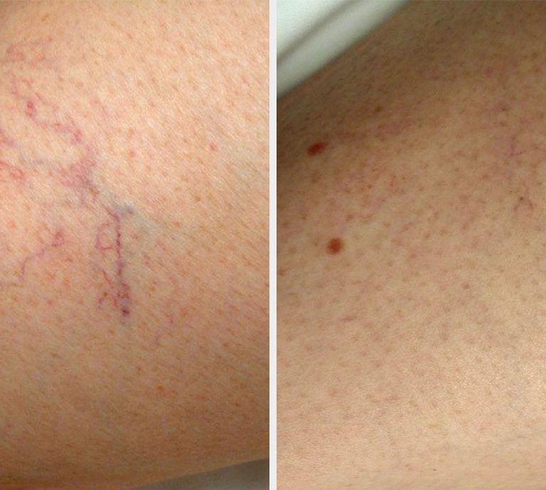 Sclerotherapy_leg_vein_removal